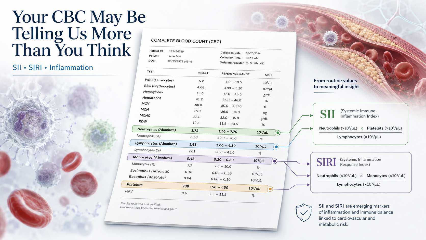 CBC laboratory report illustrating SII and SIRI inflammation markers calculated from neutrophils, lymphocytes, monocytes and platelets.