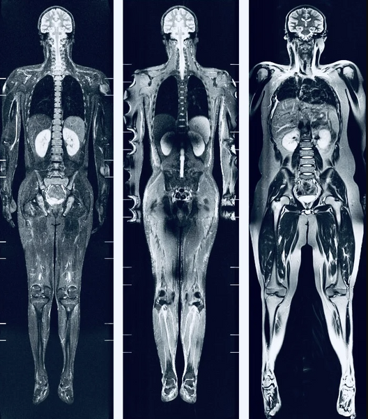 Full Body MRI (magnetic resonance imaging)